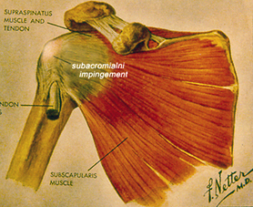 Što učiniti ako boli ramenski zglob: uzroci i liječenje - Artroza 